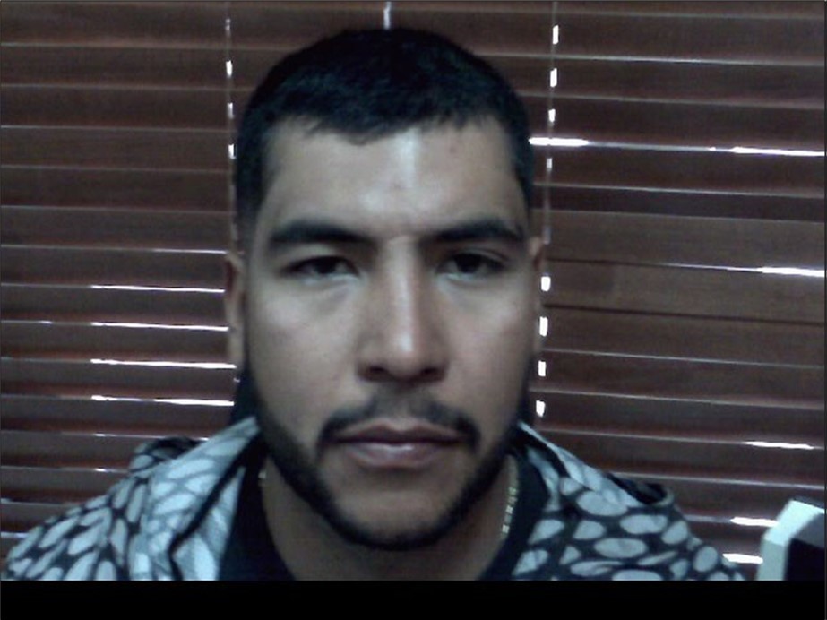 The palpebral edema on the affected side (right eye) has decreased significantly.