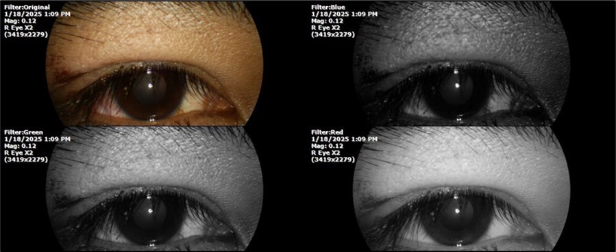 The photograph of the right eye shows moderate palpebral edema, as well as moderate conjunctival edema, especially in the inferior temporal region, where a conjunctival wound can be seen, which only affects the conjunctiva and Tenon's capsule.