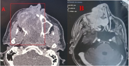 CT scan with PC injection (A) and MRI in axial sections (B) showing the lesion of the right maxillary sinus extended to neighboring structures