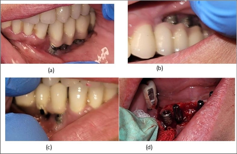 Intraoral images of the exposed implants affected by peri-implantitis: (a) quadrant 3, vestibular view; (b) quadrant 2, vestibular view; (c) quadrant 4, vestibular view; (d) quadrant 4 after removal the prosthetic restoration and uncovering the implants, vestibulo-lingual view.