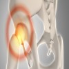 Journal of Aging Research and Healthcare - Hip Fractures
